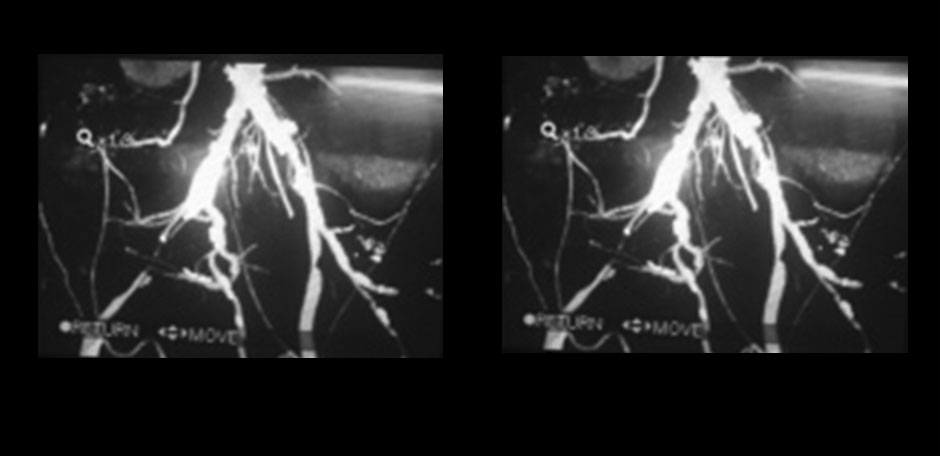 Angiography