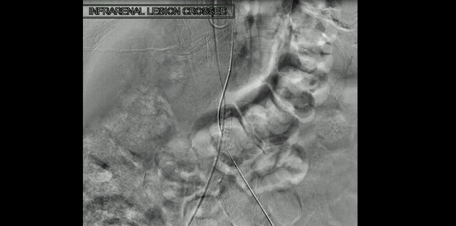 Aorto iliac disease2