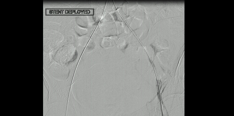 Aorto iliac disease3