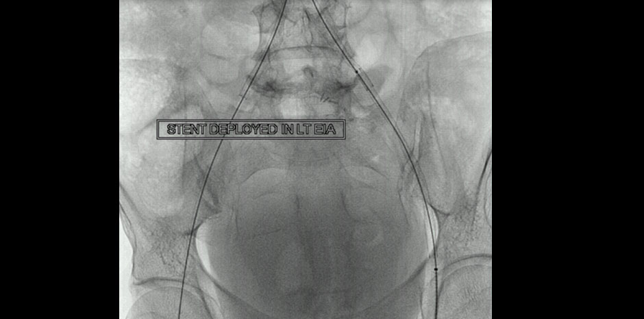 Aorto iliac disease4