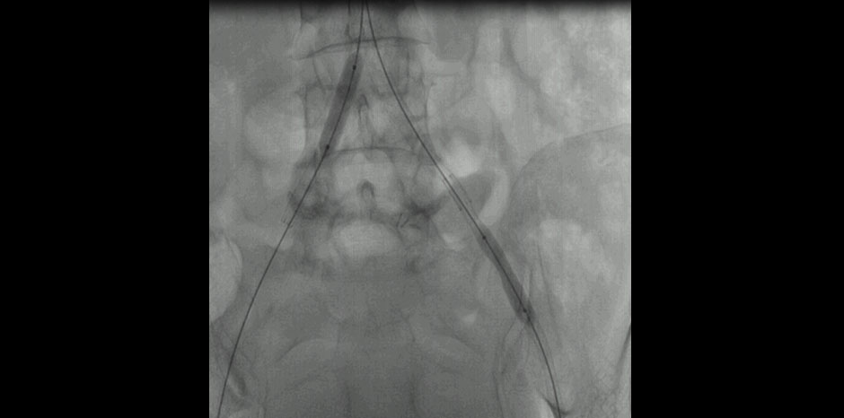 Aorto iliac disease5