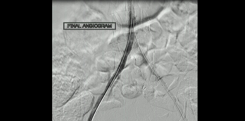 Aorto iliac disease6