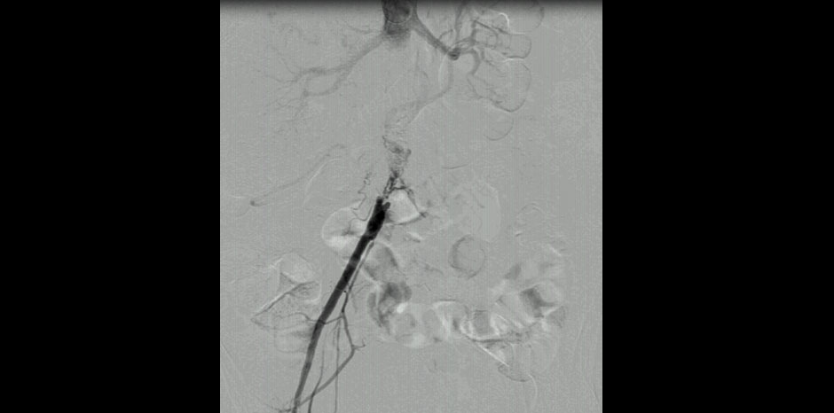 Aorto iliac disease