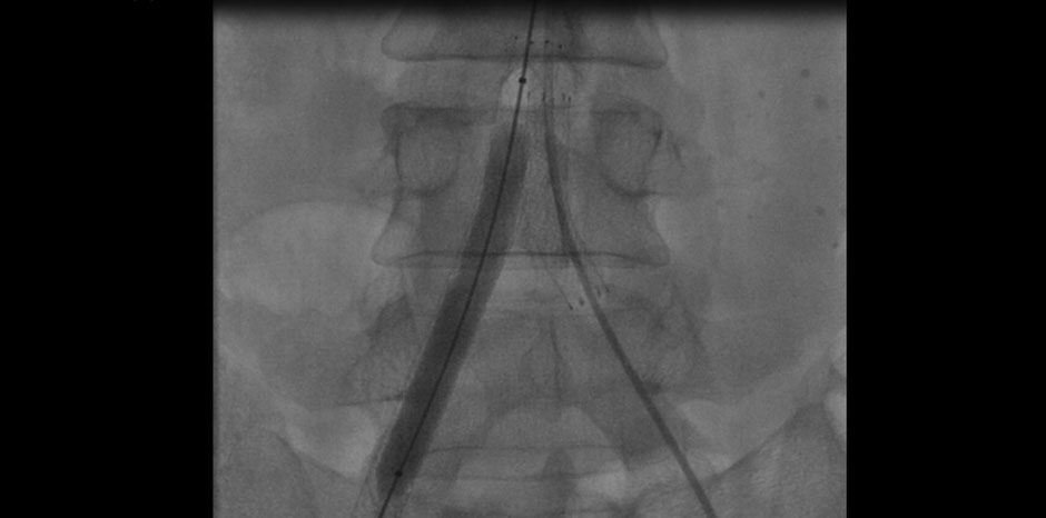 BALLOONING OF STENT
