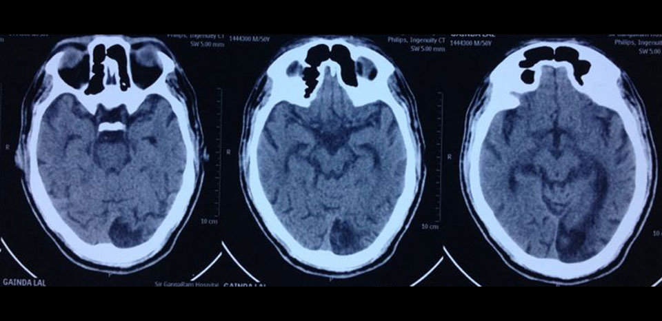 Left temporo-parieto-occipital infarct