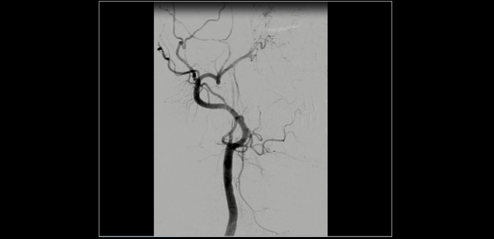 Pre-op DSA, Critical ICA stenosis