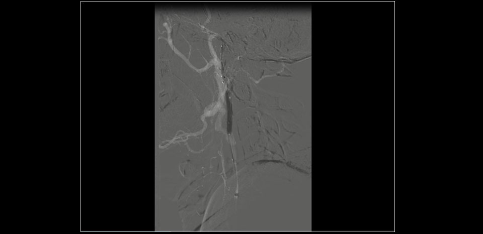 Ballooning the stent