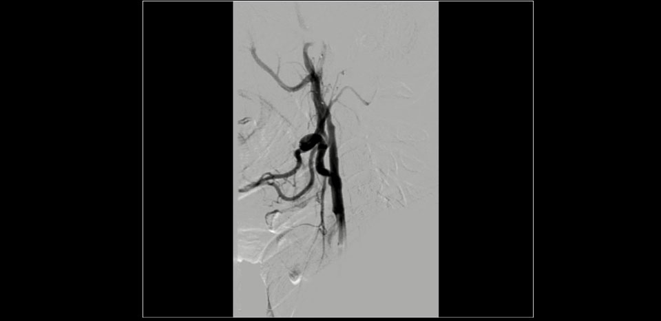 Post op result, Post stenting good flows