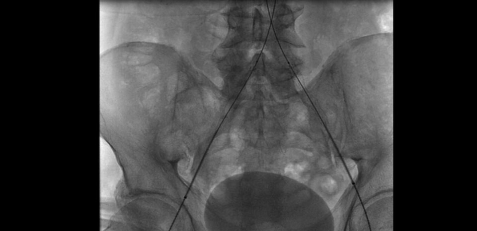 BILATERAL ILIAC STENTS DEPLOYED
