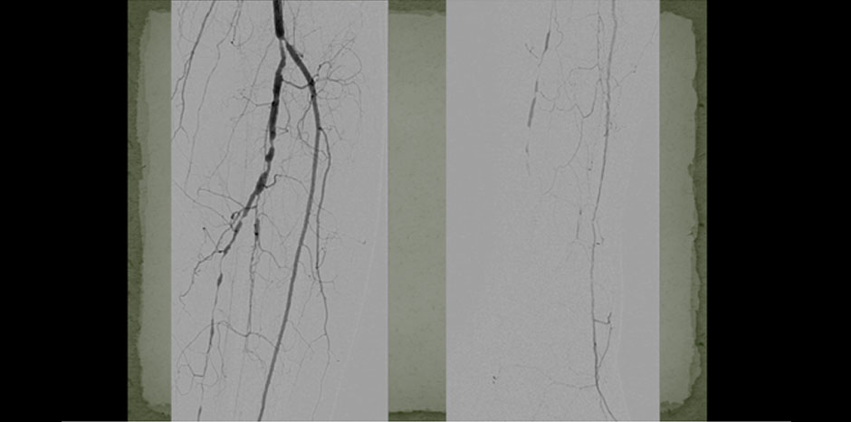 BTK lesions1