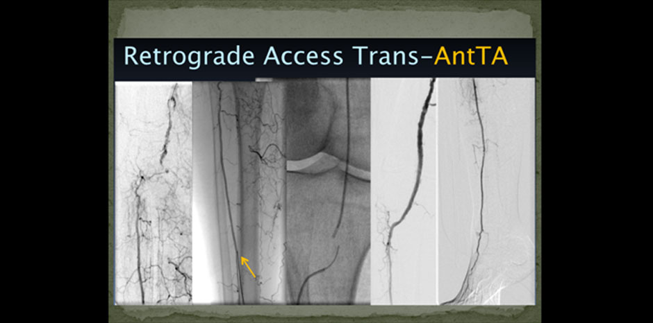 BTK lesions3