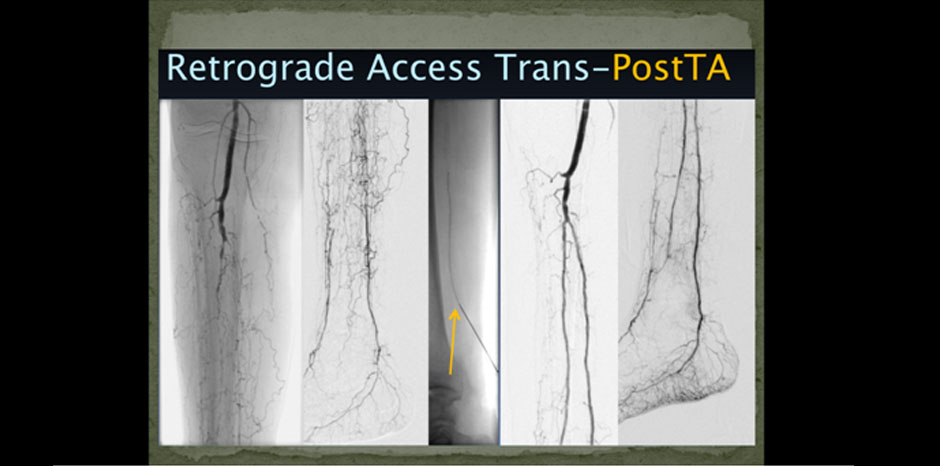 BTK lesions4