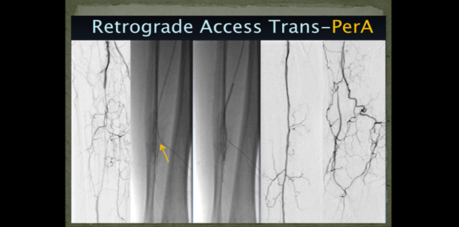 BTK lesions5