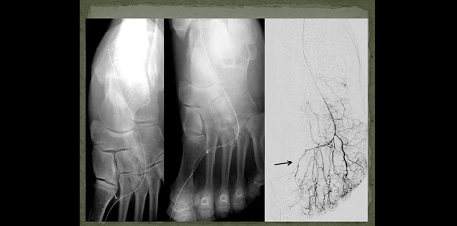 BTK lesions9