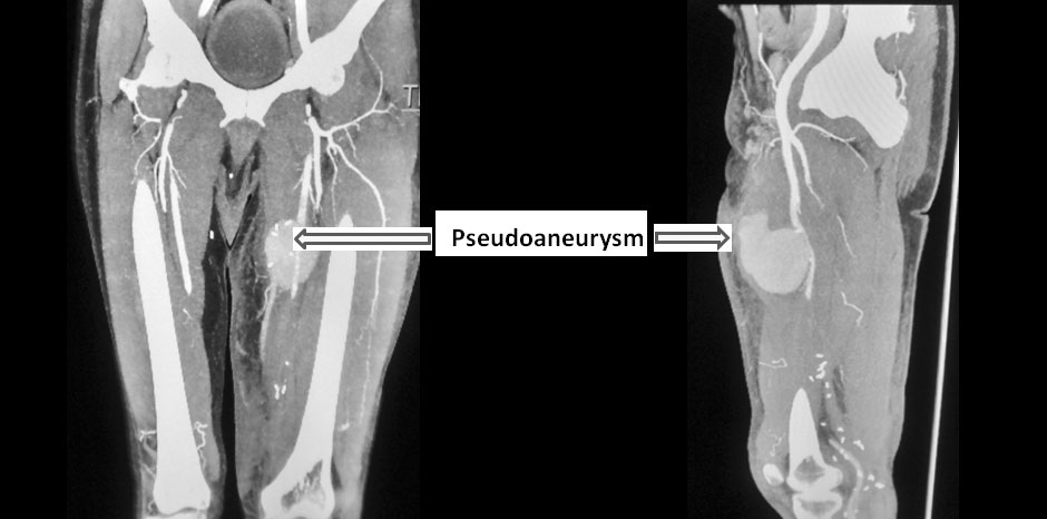 CT- ANGIOGRAM