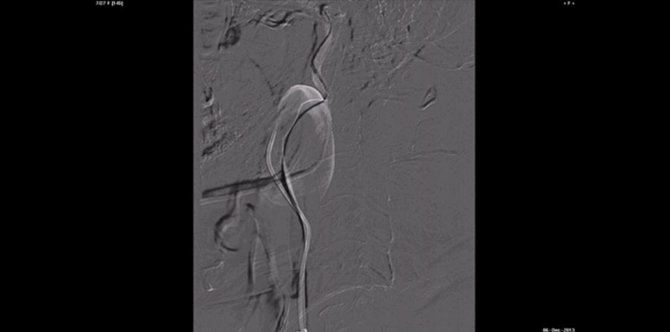 Carotid aneurysm1