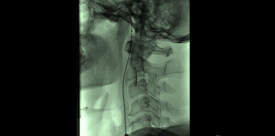 Carotid aneurysm2