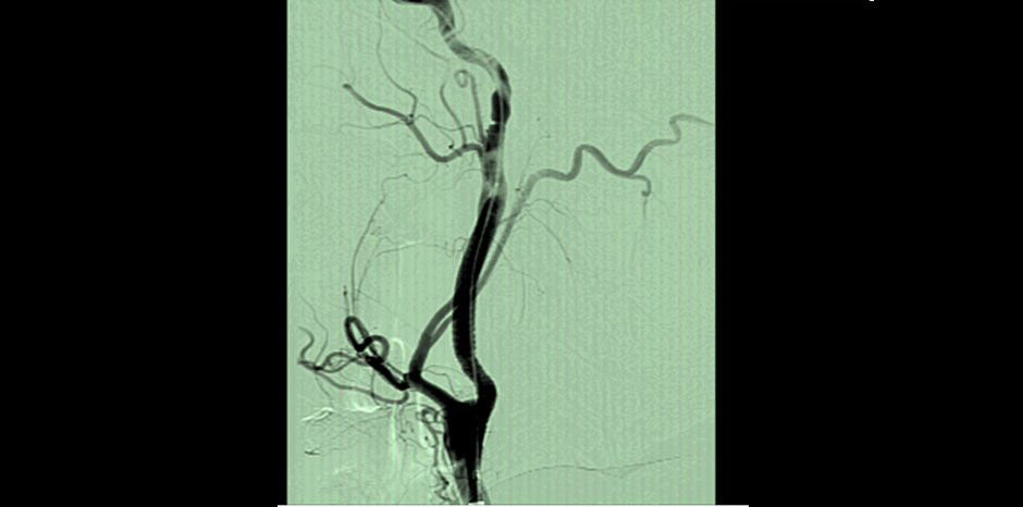 Carotid aneurysm3