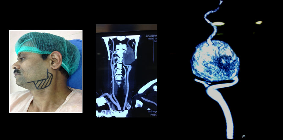 Carotid aneurysm4