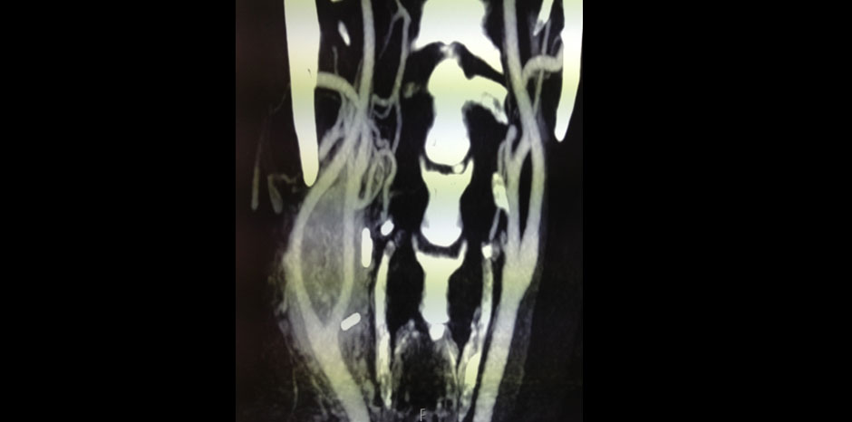 Carotid body tumour2