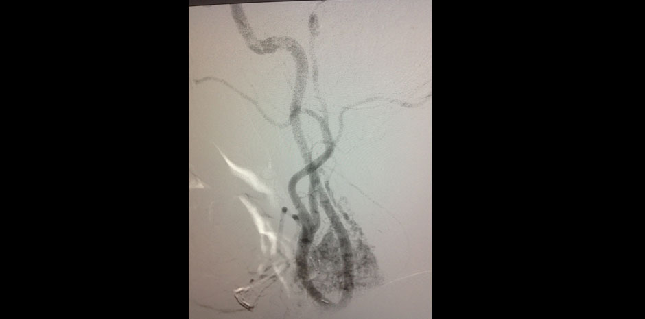 Carotid body tumour3
