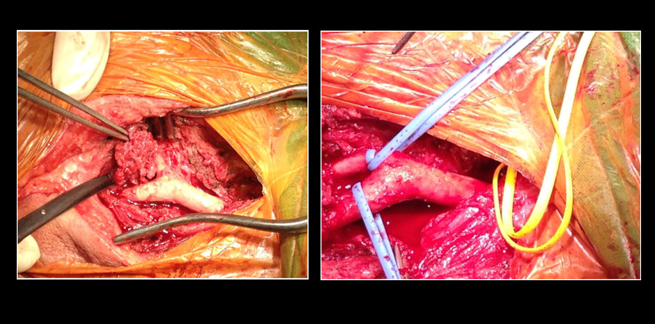Carotid body tumour4