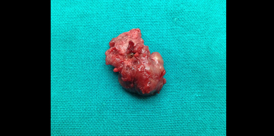 Carotid body tumour5