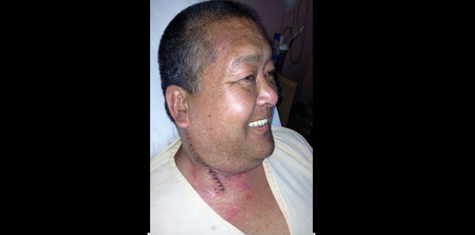 Carotid body tumour