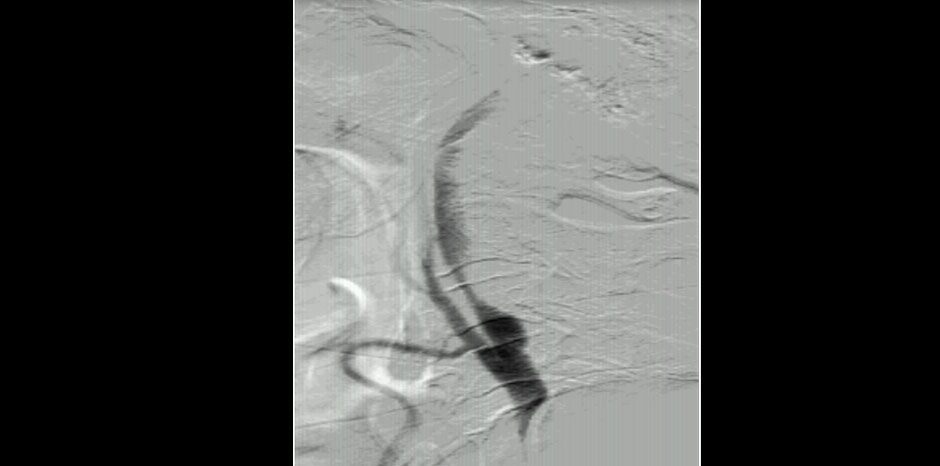 Carotid images3