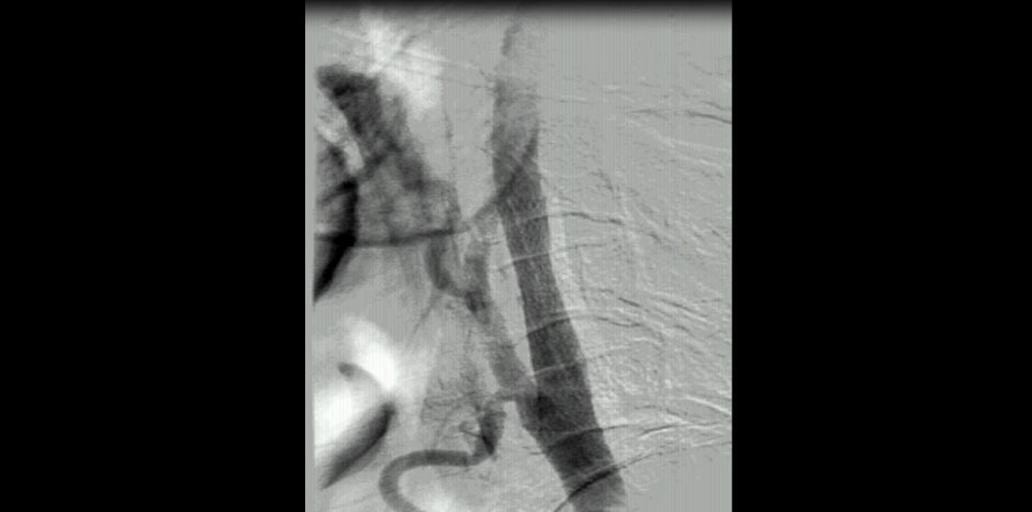 POST STENTING