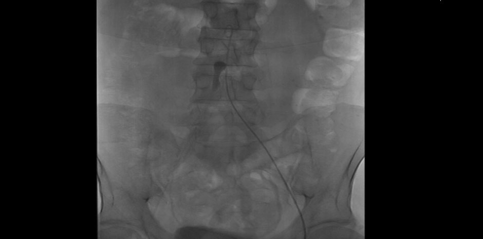 EMBOLECTOMY BEING DONE
