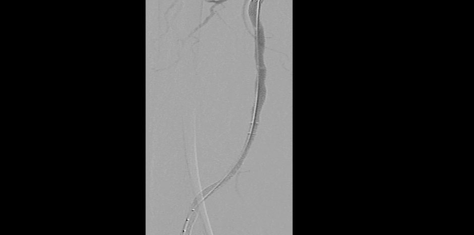 GOOD FLOW ACROSS THE STENT
