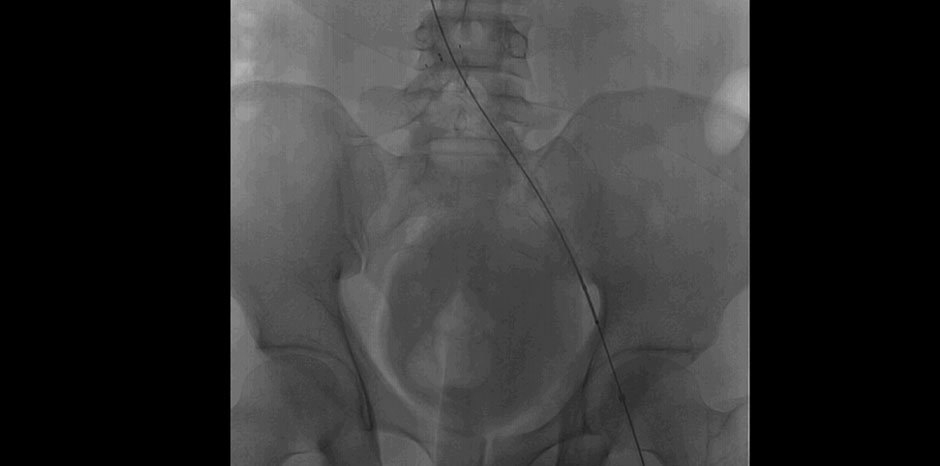 ILIAC VENOUS STENT DEPLOYED
