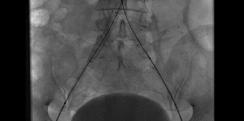 Kissing stents deployed
