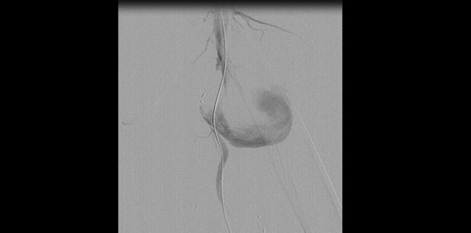 LARGE PSEUDOANEURYSM LT SFA
