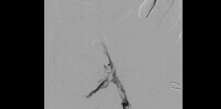 LEFT ILIAC VEIN OCCLUSION
