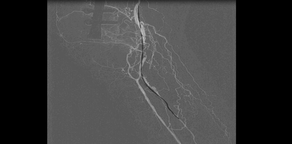 LESION CROSSED WITH WIRE
