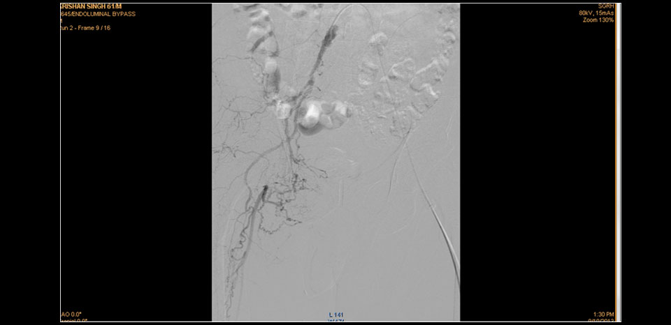 RT EIA OCCLUSION