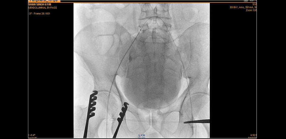 EIA STENT DEPLOYMENT