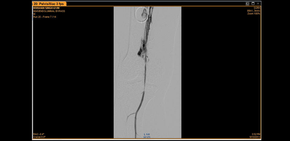 RT POPLITEAL STENOSIS