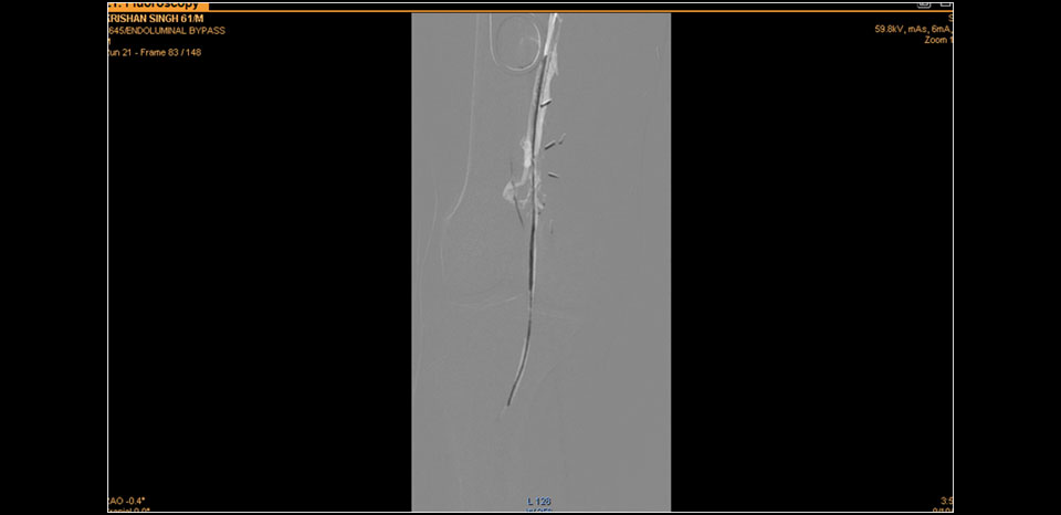 LESION CROSSED WITH WIRE