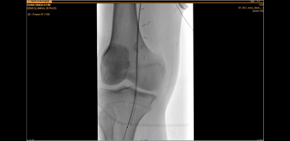 RIGHT POPLITEAL ARTERY STENTING