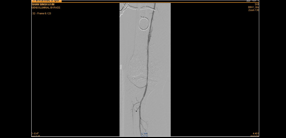 FLOW ACROSS THE LESION