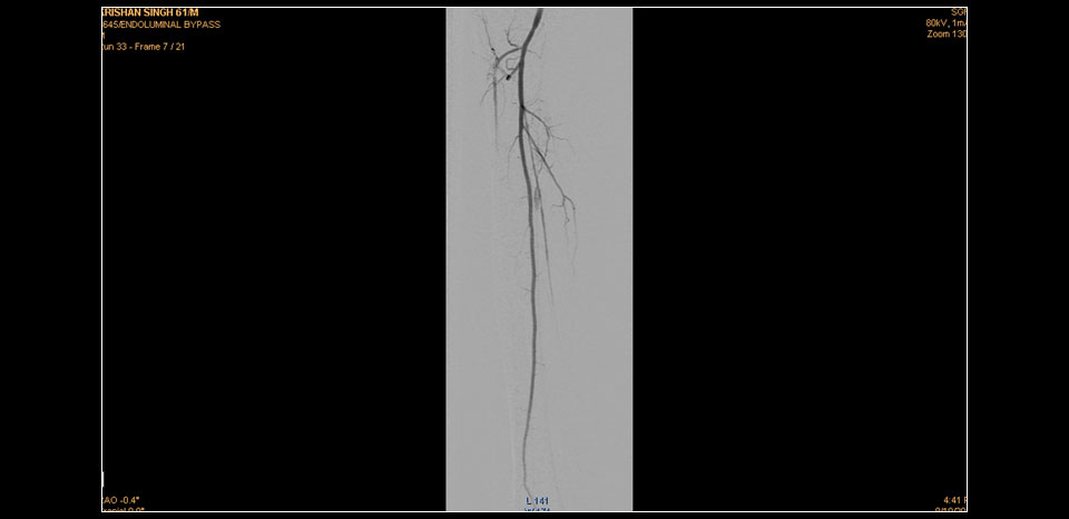 DISTAL PERONEAL RUNOFF