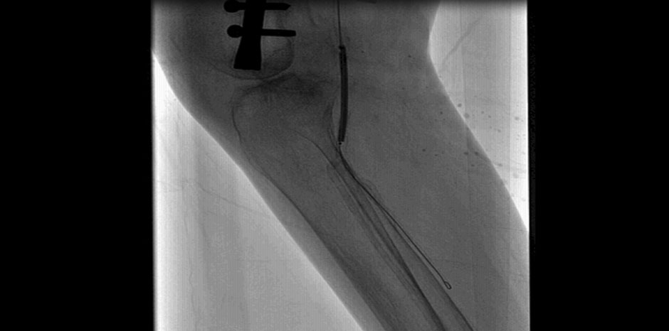 POPLITEAL ANGIOPLASTY
