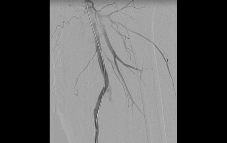 AN INTERESTING  CASE OF RECURRENT POPLITEAL ARTERY ANEURYSM