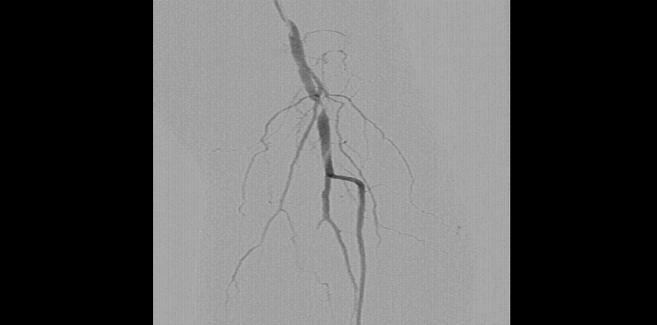 Popliteal artery stenosis
