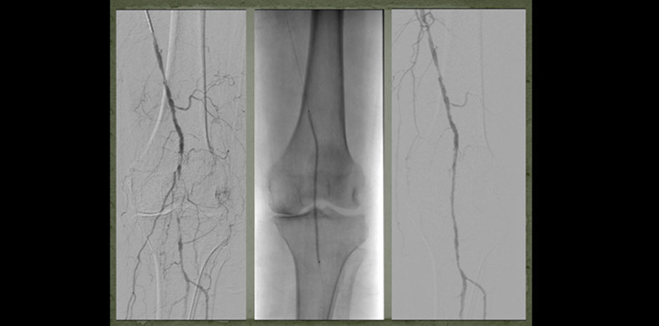 Popliteal disease1