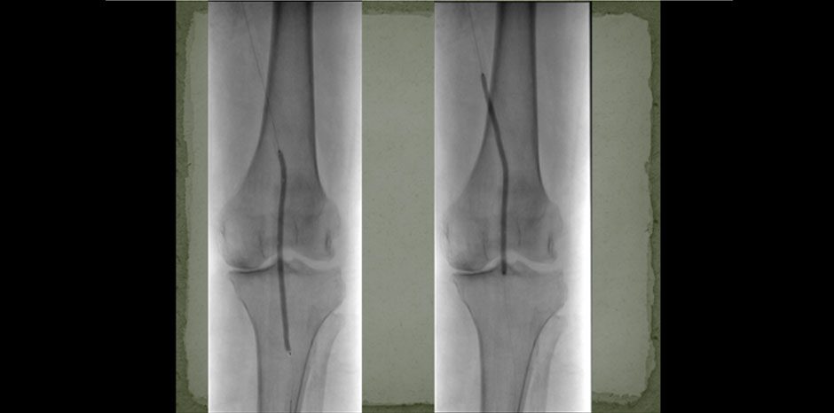 Popliteal disease3