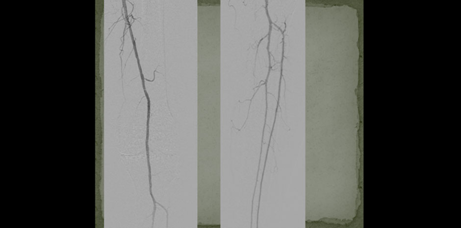 Popliteal disease4